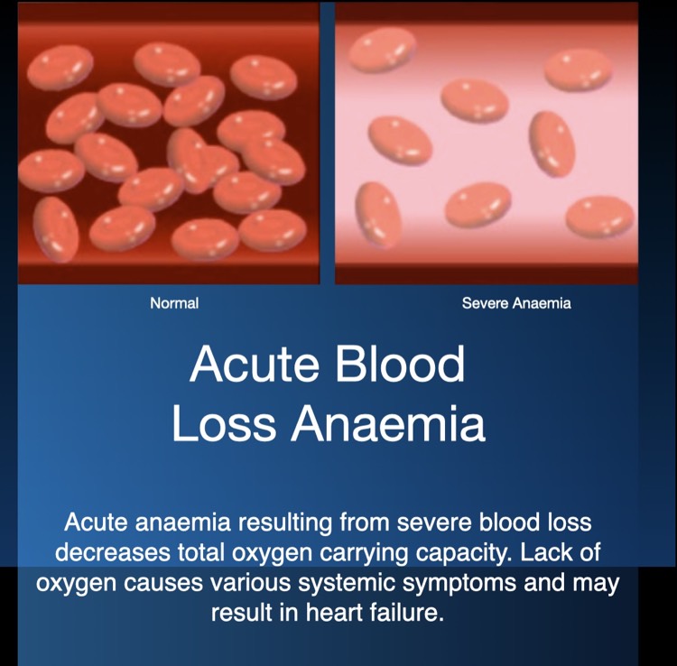 Acute Blood Loss Anaemia