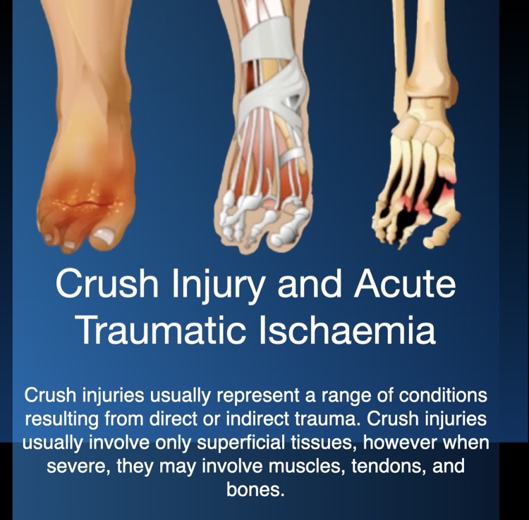 Crush Injury and Acute Traumatic Ischaemia
