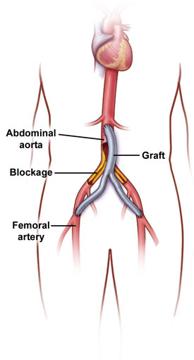 Aorta-bifemoral bypass