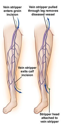 Vein%20stripping