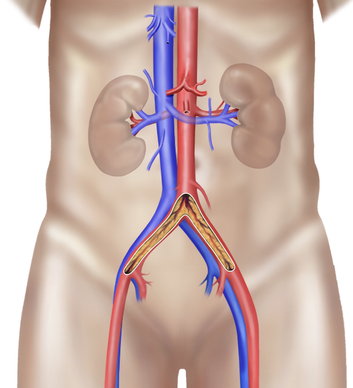 Iliac artery stenoses